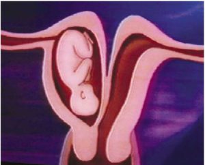 Uterus unicornis mit rudimentärem nicht kommunizierendem Horn: Schwangerschaft im nicht kommunizierendem Horn