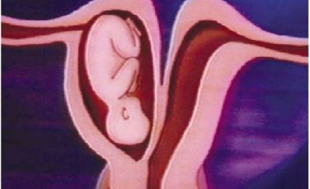 Uterus unicornis mit rudimentärem nicht kommunizierendem Horn: Schwangerschaft im nicht kommunizierendem Horn
