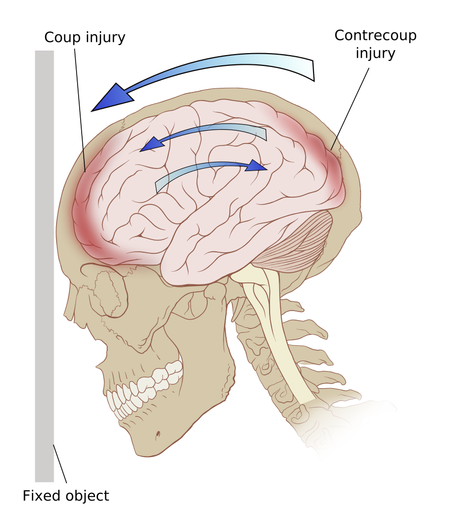 Schädel-Hirn-Trauma kann durch Trägheit oder Scherkräfte zu Verletzungen am Gehirn führen.